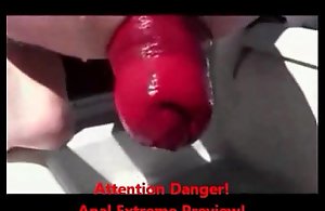 Experimental anal fisting